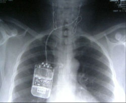Implant Device Lowers Blood Pressure