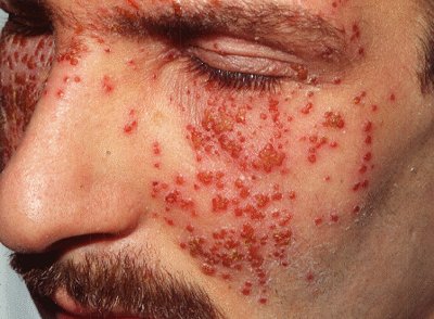 Eczema and Erectile Dysfunction Closely Tied