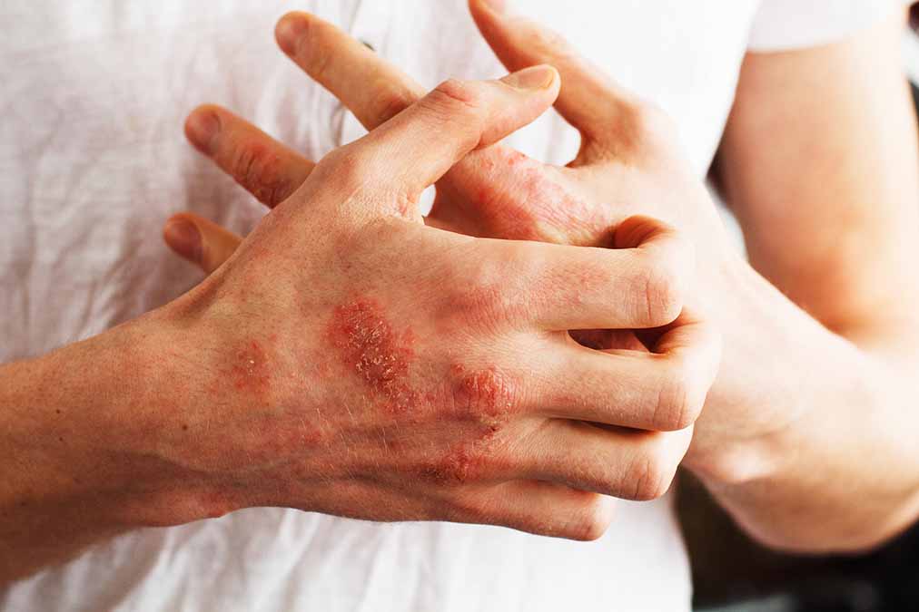 Deadly Psoriasis Consequences Reveled (study)