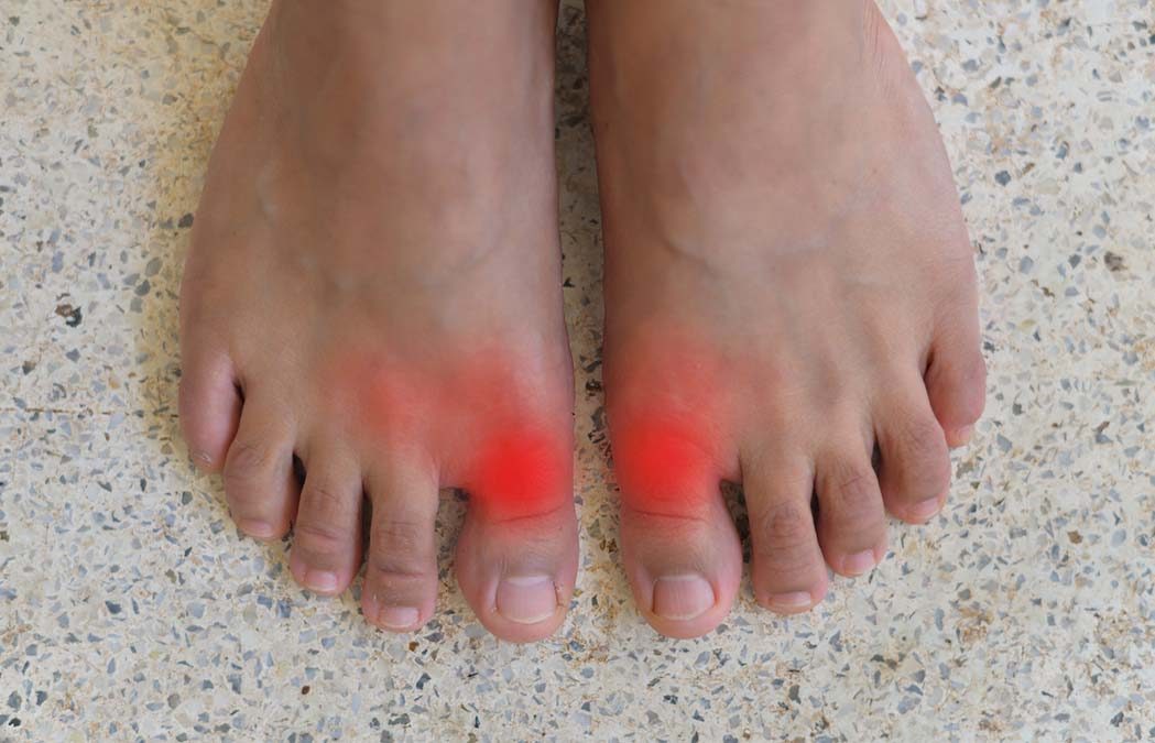 Gout and Gender Risk – Weird Connection