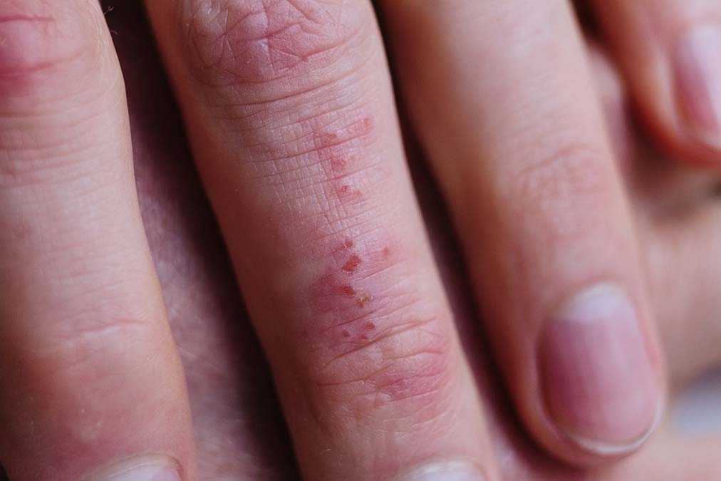 Psoriasis’s Deadly Consequences