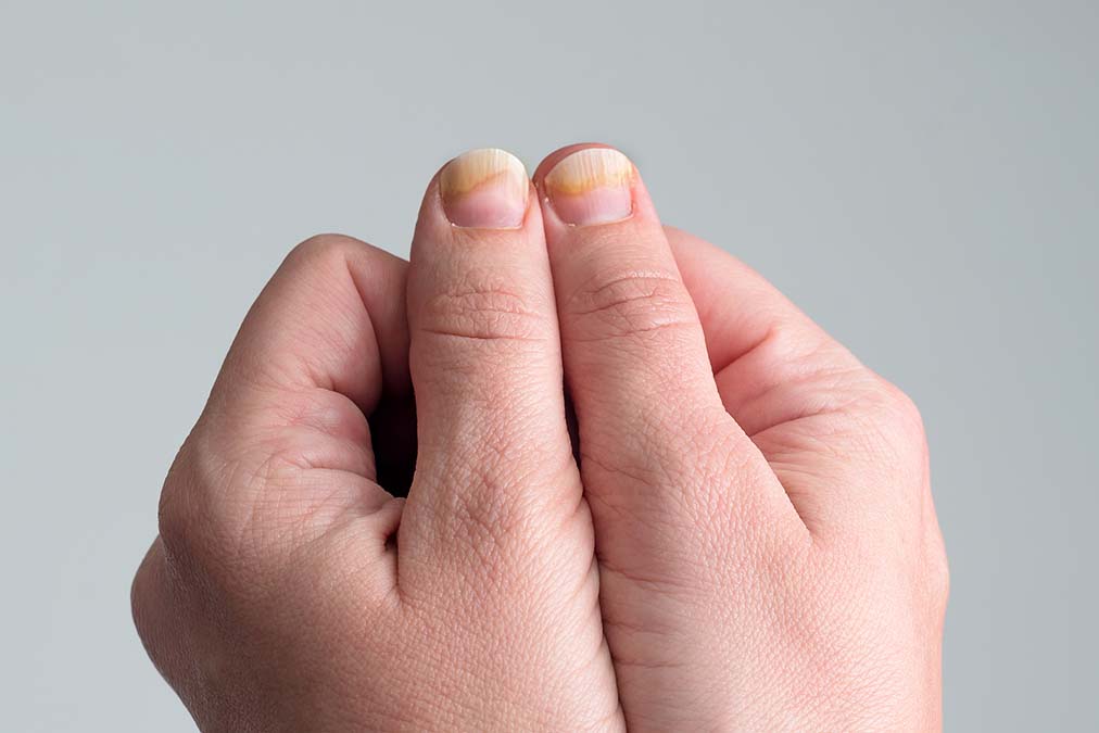 Is Your Nail Fungus Caused By Your Occupation?