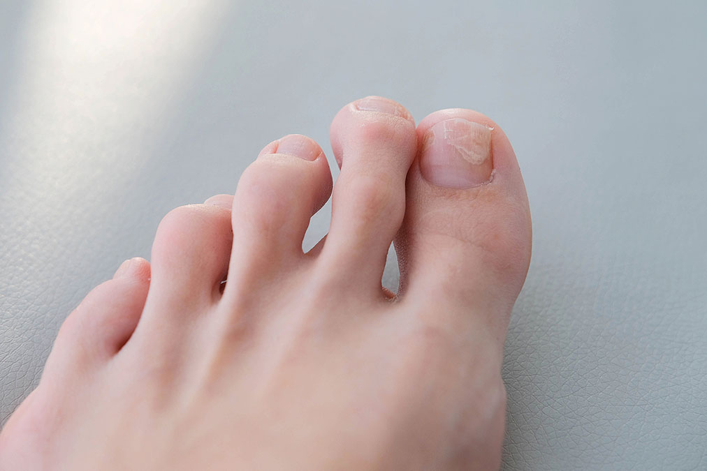Nail Fungus Home Remedy Proven 95% Effective