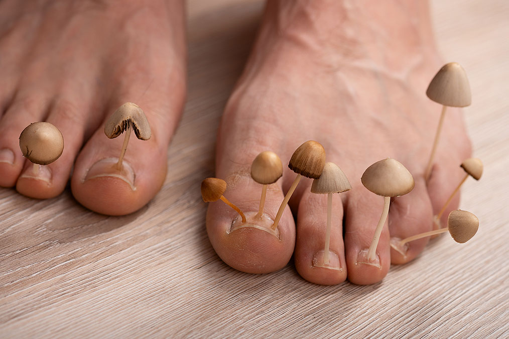 Nail Fungus and Diabetes—Strange Connection