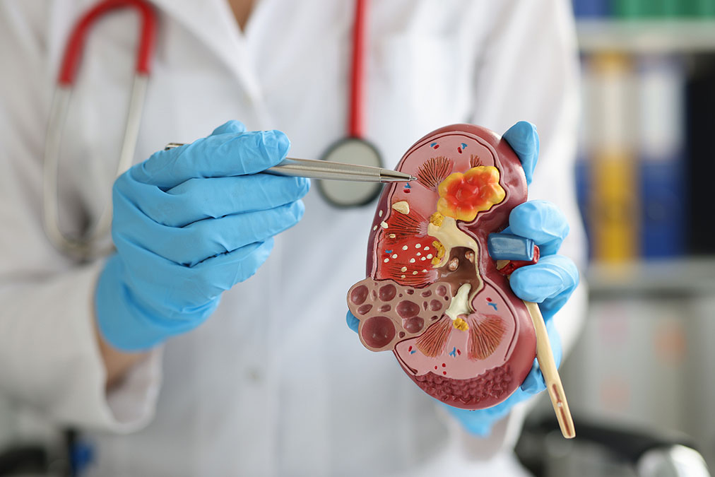 Is Chronic Kidney Disease Caused by Your Country?