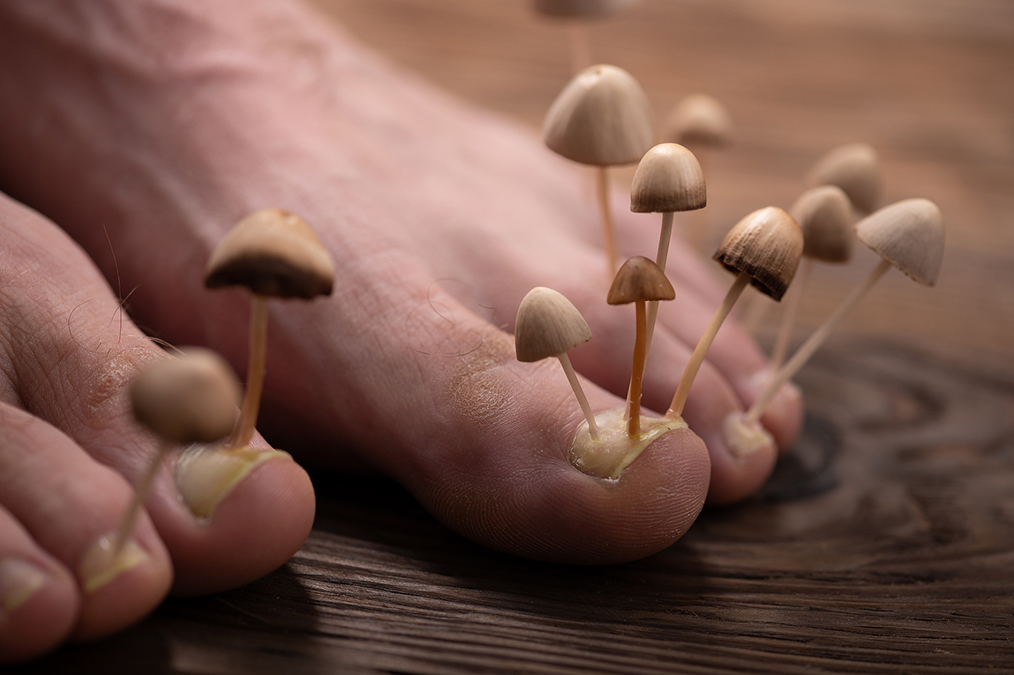 Three oils kills Nail Fungus (better than drugs)