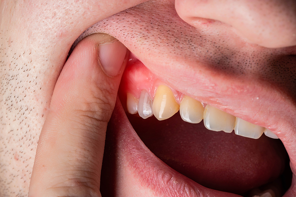 When painful gums turn life-threatening
