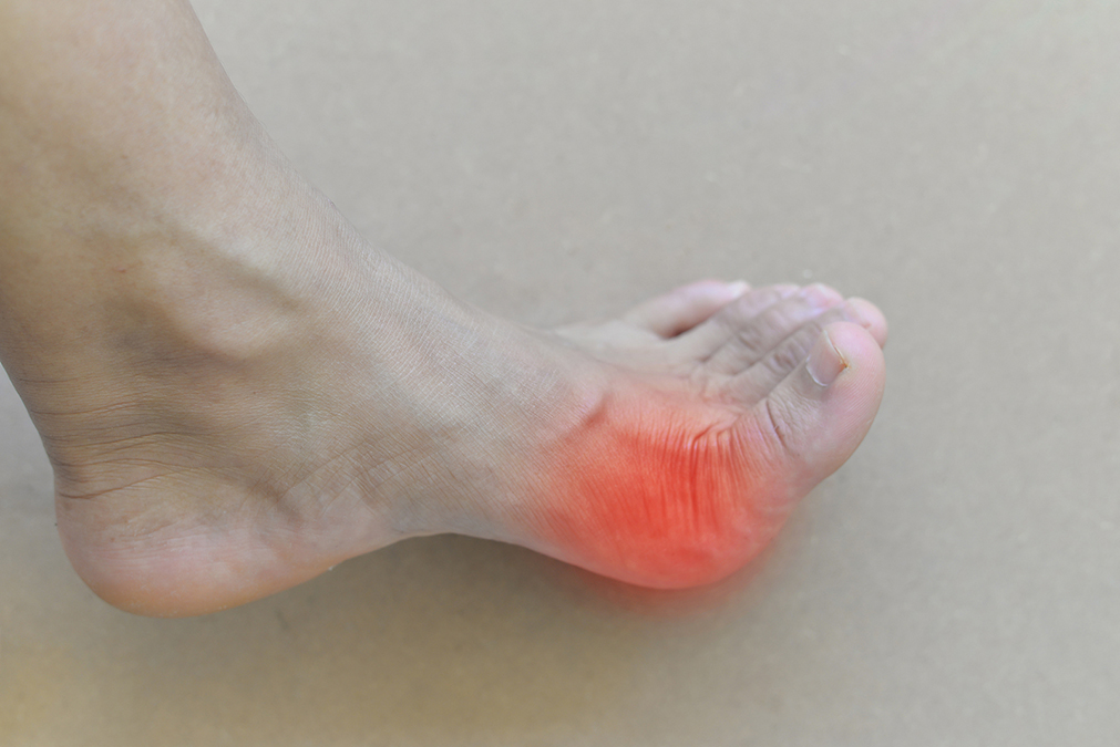 How Gout fix starts with your intestines