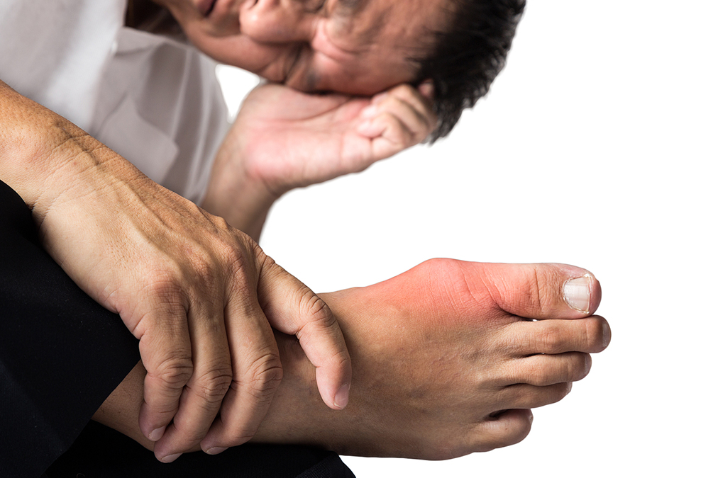 Gout tied to hidden gut bacteria